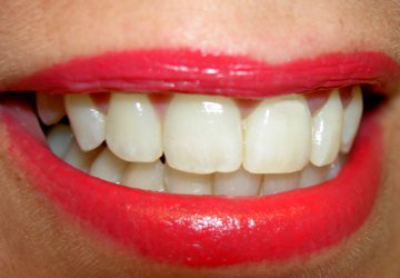Teeth Whitening Image